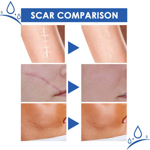 Crema Suave para <span class=keywords><strong>Eliminar</strong></span> Cicatrices Antiguas y Nuevas, Queloides, Marcas de Acné, Estrías, Segura para Mujeres Embarazadas - Product Image 4