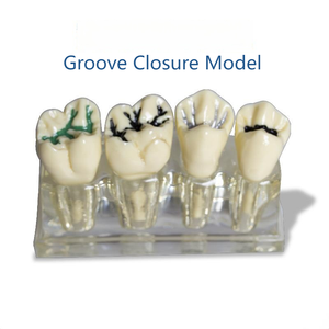 Modelo <span class=keywords><strong>de</strong></span> Sellador Dental <span class=keywords><strong>para</strong></span> <span class=keywords><strong>Fosas</strong></span> <span class=keywords><strong>y</strong></span> <span class=keywords><strong>Fisuras</strong></span> |   Modelo <span class=keywords><strong>de</strong></span> Dientes Removibles a Escala Real 4:1 <span class=keywords><strong>para</strong></span> Enseñanza Dental <span class=keywords><strong>y</strong></span> Práctica <span class=keywords><strong>de</strong></span> Exámenes - Product Image 6