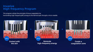 Máquina <span class=keywords><strong>de</strong></span> Rejuvenecimiento Facial con Microagujas RF Fraccionadas No Invasiva, Compatible con EU/US, para Eliminación <span class=keywords><strong>de</strong></span> Estrías - Product Image 5
