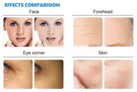 Appareil portable de soin Hydra pour l'élimination des points noirs, peeling à jet d'oxygène, dermabrasion au diamant pour les rides et les ridules