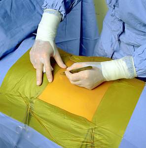 フィルムドレッシングEOS超薄型通気性ヨウ素抗菌手術切開ドレープ接着剤PUフィルム - Product Image 4