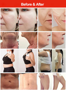 Máquina Onda Pro Coolwave No Invasiva de Última Generación con 2 Manijas para Eliminación de Grasa Abdominal, Reducción de Celulitis, Lifting Facial y Reafirmación de la Piel - Product Image 2