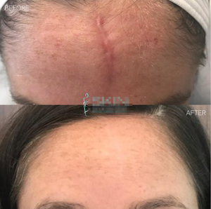 2023 fractional Laser CO2 loại bỏ mụn trứng cá chống lão hóa loại bỏ nếp nhăn Tattoo Pigment loại bỏ Laser máy đẹp CO2 Laser - Product Image 3