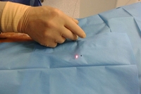 Fibre médicale Arfurla pour varices, fibre radiale EVLT