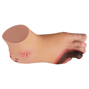 Modelo de Úlcera Diabética del Pie, Varias Etapas, Modelo de Enfermedad, Ciencia Médica - Product Image 4