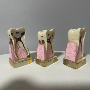 Nha khoa Răng mô hình PVC manikin cho giảng dạy hàm răng giả phân rã & sâu răng quá trình trong y tế khoa học - Product Image 6