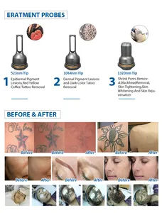 Kes Multifunctionele Pico Laser Tattoo Verwijdering Machines Huid Verjonging Picoseconde Laser Voor Tattoo Verwijdering