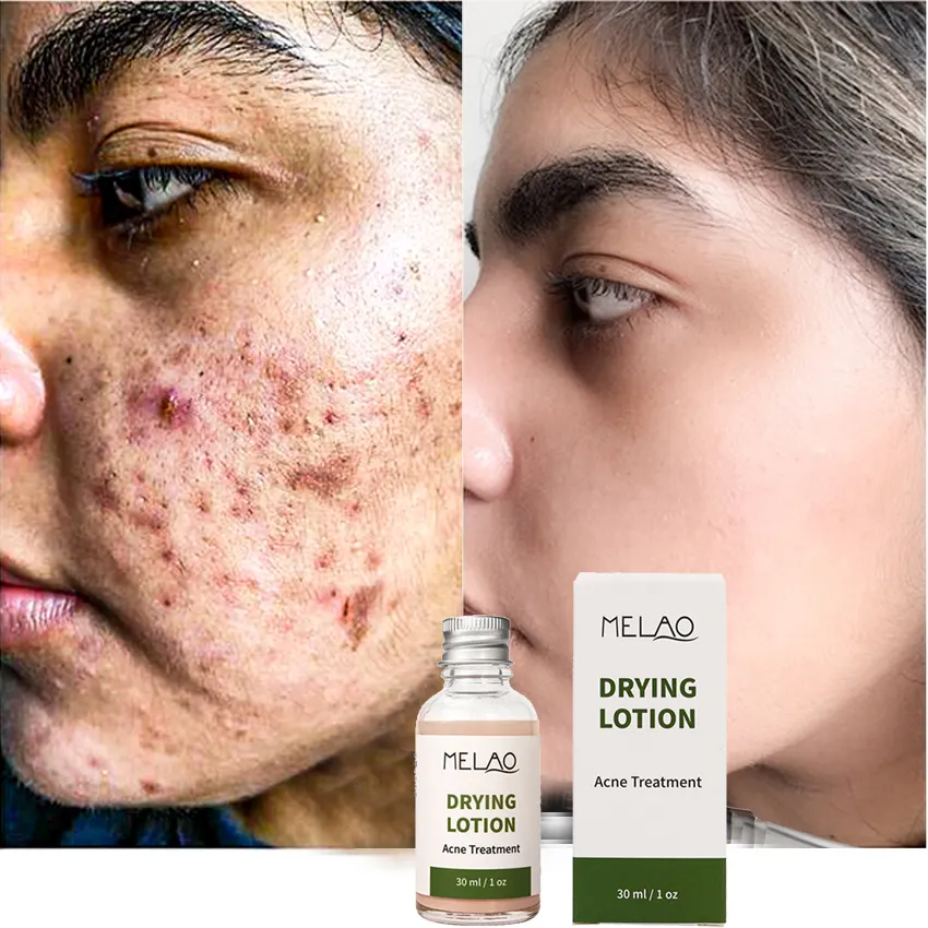 MELAO en iyi cilt bakımı OEM sivilce akne tedavisi salisilik asit yüz solüsyonu kurutma losyonu erkekler ve kadınlar için