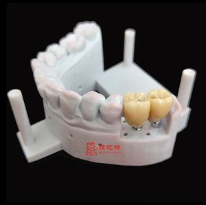 Couronnes d'implants avec excellente prothèse <span class=keywords><strong>dentaire</strong></span> plus confortables et plus belles que les prothèses et les ponts mobiles traditionnels - Product Image 4