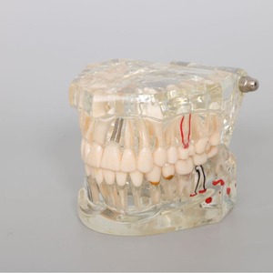 Modèle dentaire transparent de haute qualité, nouveau modèle d'affichage pathologique pour prothèses dentaires et implants - Product Image 5