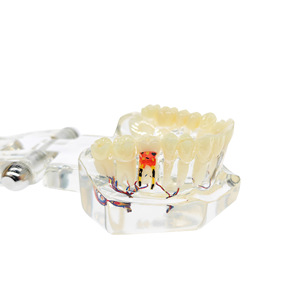 Modelo patológico hemisférico transparente, modelo dental patológico completo, modelo dental desmontable, implante - Product Image 4