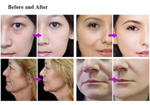 Dispositivo de Belleza Golden Eye, Máquina de Infusión para el Cuidado de los Ojos, Equipo Portátil para el Cuidado de la Piel para Salón de Belleza - Product Image 3