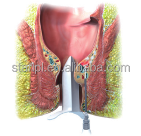 Perawatan Laser ambeien 980nm 1470nm, alat medis procologi Fistula Logi Anal penghilang pembuluh darah varises - Product Image 3