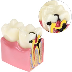Modelo Educativo de Caries Dentales, Ampliado 6 Veces en Sección Transversal, Material de Resina para Educación Anatómica y Enseñanza de Salud Dental - Product Image 6