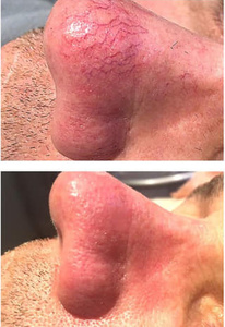 Máquina de Limpieza Facial para Eliminar <span class=keywords><strong>Arañas</strong></span> <span class=keywords><strong>Vasculares</strong></span>, Nueva Tendencia en Limpieza Facial, 980nm para Eliminación de Varices - Product Image 3