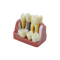 Modèle anatomique dentaire 4 fois plus grand pour implants, couronnes et bridges, en résine, pour l'analyse, la démonstration et la formation en dentisterie amovible
