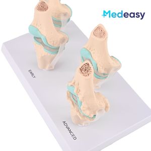 Levensgroot 4-fasen kniegewrichtsmodel Pathologisch anatomisch <span class=keywords><strong>model</strong></span> Schadewaardigheidsdemonstratiemodel Osteoartritismodel voor onderwijs - Product Image 4