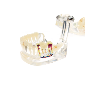 Modèle de dents pour maladies implantaire, conception claire, modèle d'étude des dents implantaire, modèle de pathologie <span class=keywords><strong>dentaire</strong></span> pour usage <span class=keywords><strong>dentaire</strong></span> - Product Image 3