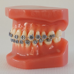 Dents dentaires orth modèles orthodontiques avec supports - Product Image 1