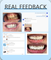 Suministro de fábrica OEM ODM Smile Teeth Kit 5 LED Light Dental Blanqueamiento de dientes Kit para el hogar