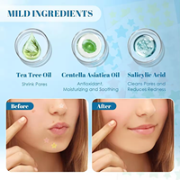 CM 200 pièces en gros Patch de bouton de Style étoile patchs d'acné hydrocolloïdes pour le visage infusé avec de l'huile d'arbre à thé Centella