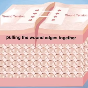 Terommed hidrokoloid jahitan luka penutupan hidrocoolid Zip jahitan penutupan perekat Zip Lock jahitan - Product Image 3