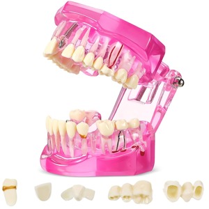 Modelo de Dientes para Implantes Dentales con Dientes Removibles, Demostración Patológica de Dientes Estándar para Dentistas, para Navidad - Product Image 1