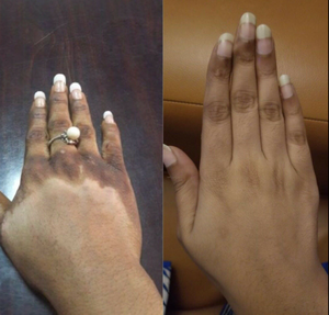 Aceite Exfoliante Amarillo <span class=keywords><strong>Extra</strong></span> Fuerte al por Mayor para Blanquear la Piel y Eliminar Manchas Oscuras en los Nudillos con Su Propia Marca - Product Image 2