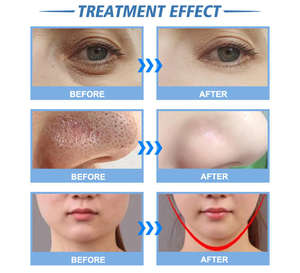 Huidverzorgingsapparaat 14-in-1 dieptereiniging diamant microdermabrasie hydro zuurstof gezichtsbehandeling met US/IT stekker compatibiliteit - Product Image 6