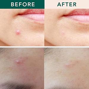 Parche Hidrocoloide Ultrafino Invisible a Prueba de Agua <span class=keywords><strong>para</strong></span> el Acné con Ácido Salicílico y Aceite de Árbol de Té <span class=keywords><strong>para</strong></span> la Curación del Acné - Product Image 4