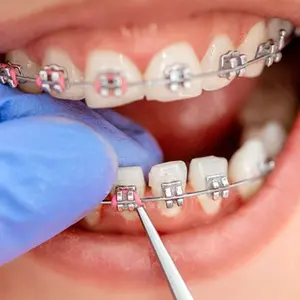 + Guber Alta Qualidade Cor Misturada O anel Moda Ortodôntica Super Elástica Ligadura Laços De Borracha para Aparelhos Dentários