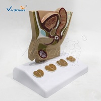 Modèle de prostate 1/2 taille naturelle, section médio-sagittale, normal/comparaison HBP, anatomie du bassin et des testicules, enseignement médical