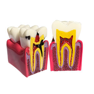 Kits éducatifs pour l'enseignement dentaire : Modèle de comparaison des caries 4x, Modèle de cavité buccale, Modèle de dent - Product Image 1