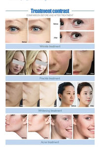 Non-Invasive HydraDermabrasion <b>8</b> Bar Big Power Hydrating Microdermabrasion Skin Care <b>Machine</b> <b>Facial</b> Rejuvenation - Product Image 6