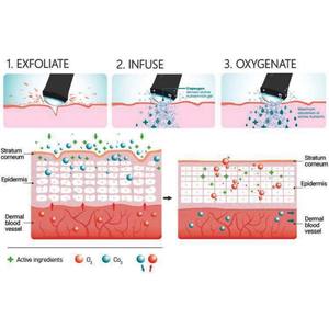 Belleza Y Cuidado Cá Nhân Da Scrubber Microdermabrasion Chất Tẩy Rửa Mặt Massage Hydra Oxy Máy Trên Khuôn Mặt - Product Image 5