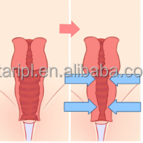 Classe 4 1470nm Vaginal Tense Diode Laser Gynécologique 980nm Rajeunissement de la peau LVR Gynécologie Équipement de thérapie par la lumière rouge - Product Image 5