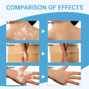 สเปรย์รักษาโรคด่างขาว 30 มล. ขายส่ง สเปรย์ดูแลผิว ลดจุดด่างขาว - Product Image 4