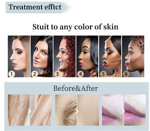 Máquina Láser de Diodo portátil <span class=keywords><strong>Milesman</strong></span> 755 808 1064 Láser de alejandrita para depilación permanente Enchufe del Reino Unido - Product Image 6