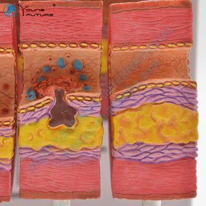 Modelo educativo de aterosclerosis de arteria cardiovascular de Anatomía Humana - Product Image 4