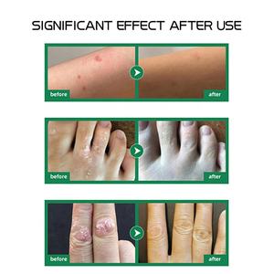 Espray <span class=keywords><strong>para</strong></span> tratamiento de los síntomas de la Psoriasis de la piel del cuero cabelludo irritado con logotipo personalizado, escamas, escamas, grietas, alivio de picaduras - Product Image 3