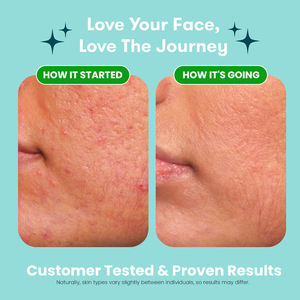 Set <span class=keywords><strong>de</strong></span> Cuidado Facial FATAZEN: Tónico Antioxidante para Control <span class=keywords><strong>de</strong></span> Grasa y Reducción <span class=keywords><strong>de</strong></span> Poros, Limpiador Facial <span class=keywords><strong>de</strong></span> Limpieza Profunda, Eliminación Suave del Acné, Cuidado Antiacné - Product Image 5