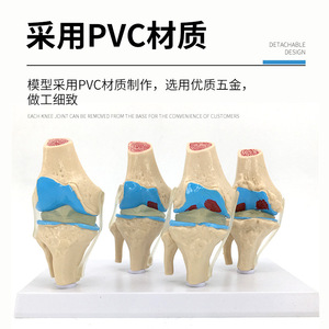 Modelo patológico humano de articulación de rodilla; lesiones; articulación de rodilla degenerativa/enfermedad; comunicación sobre cirugía artroscópica. - Product Image 4