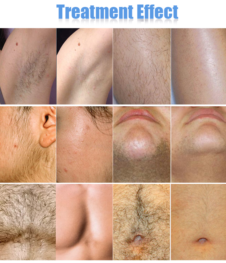 Body 808nm Diode Laser Hair Removal Machine Painless