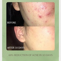 Ensemble de soins de la peau contre l'acné Sérum nettoyant pour le visage Crème Réduction des pores Acide salicylique Kit d'élimination des boutons pour tous les types de peau