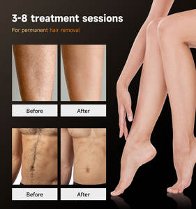 2025 AI análisis Diodo Láser Depilación Dream Plus para salón láser belleza equipo 1600W 1800W 2000W 755 808 1064nm - Product Image 5