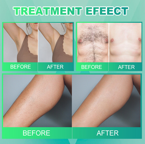 Pinset Pencabut rambut elektrik kulit Salon, alat penghilang rambut elektrolisis, Untuk penghilang bulu permanen, <span class=keywords><strong>2026</strong></span> - Product Image 5