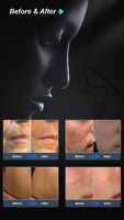 Teknologi Baru SANHE BEAUTY SC-2 Mesin Laser Fraksional CO2 Portabel Panjang Gelombang 10600nm Tingkat Perawatan 0.36-25 untuk Bekas Jerawat