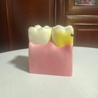 Modelo DE EDUCACIÓN anatómica para caries dental 6 demostraciones de sección transversal bilateral para estudio de ciencia médica