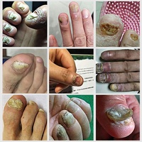 Sérum Anti-Mycose Ongles 7 Jours Marque Blanche Traitement et Réparation Mains Pieds Gel Anti-infectieux