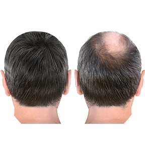 เส้นใยสร้างคอลลาเจนทำจากไลโอฟิลด์พร้อมเดอร์มาเพนสำหรับการเจริญเติบโตของเส้นผมสารละลายป้องกันการหลุดร่วงของเส้นผมจากเส้นผม - Product Image 4